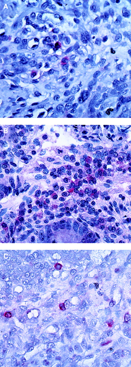 Fig. 3. Indirect alkaline phosphatase staining on frozen sections of digestive biopsy specimens with histologic GVHD. / (A) In the infiltrate of the lamina propria, 2 of 3 labeled cells have bilobulated nuclei. Antibody directed against eosinophil peroxidase, × 300 magnification. (B) Staining is only found on inflammatory cells of the lamina propria, and not on epithelial glandular cells. Mononuclear and polynuclear cells are labeled. Antibody directed against IL-5, × 250. (C) Some inflammatory cells and mononuclear and polynuclear cells are stained in the inflammatory infiltrate of the lamina propria. Antibody directed against eotaxin, × 300 magnification.