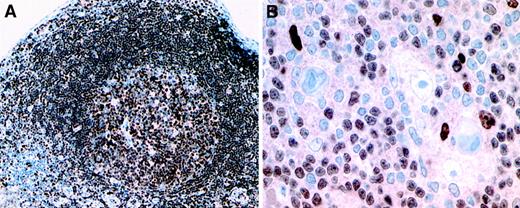 Fig. 1. Expression pattern of PU.1 in reactive lymphoid tissue and in classical Hodgkin disease. / (A) Uniform nuclear expression of PU.1 by germinal center and follicular mantle B cells in tonsillar lymphoid tissue. (B) Hodgkin and Reed-Sternberg cells show absent PU.1 expression, whereas small B cells and occasional histiocytes express the protein in the nuclei (immunostains using a PU.1 monoclonal antibody and the EnVision method using diaminobenzidine as chromogen, brown reaction product). Isotype-matched irrelevant antibodies did not show positive staining patterns on the same tissues. Original magnification A, × 100; B, × 250.