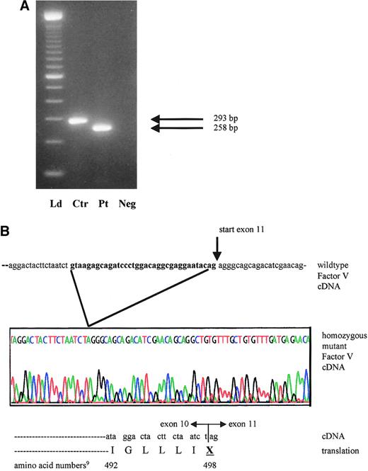 Fig. 2. mRNA analysis of proband with activation of cryptic exon 10 splicing from 1701G>T. / (A) Reverse transcription–PCR products of factor V cDNA spanning exon 10 and including part of exons 9 and 11. The expected wild-type product in the control (Ctr) measures 293 bp, whereas the patient (Pt) has a 35-bp deletion and a product size of only 258 bp. Neg indicates reagent control in RT-PCR; Ld, ladder. (B) Sequence tracing of the affected area in the proband's mutant cDNA and protein product, compared with the wild-type factor V cDNA from the same region. The sequence shown in bold reflects the 3′ exon 10 segment, which is illegitimately spliced out in the patient.
