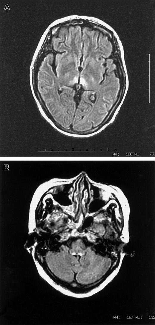Fig. 1. (A,B) MRI images in axial fluid attenuated inversion recovery sequence showing T2-weighted hyperintense lesions surrounding third ventricle (1A) and dorsal aspect of medulla (1B).