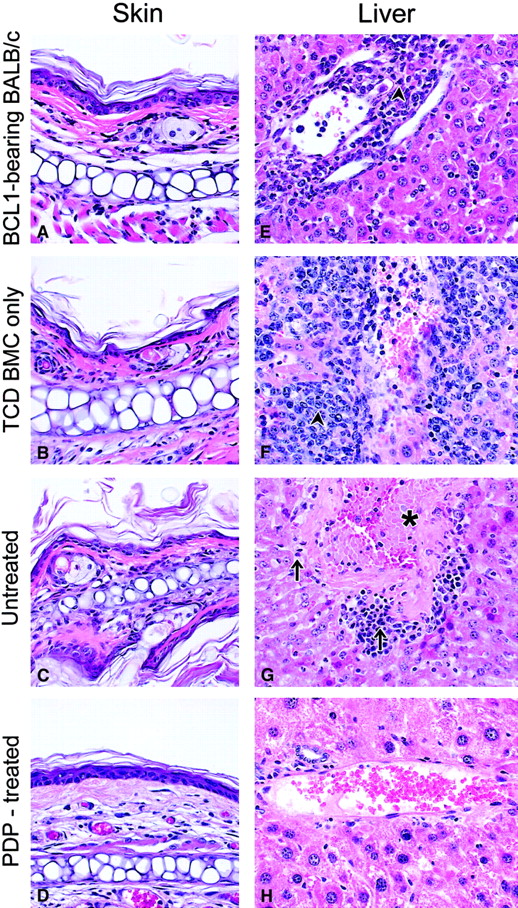 Fig. 5. Histologic analyses. / Representative skin (A-D) and liver (E-H) sections from different groups of mice (H&E stain, ×100). Arrowhead shows BCL1 leukemia/lymphoma cells growing in the liver; arrow shows infiltrating lymphocytes; asterisk shows fibrosis of portal tracts in the liver. Analyses included 4 groups of mice: a normal BALB/c mouse inoculated with BCL1 30 days ago (A,E); a BCL1-bearing mouse transplanted with T-cell–depleted bone marrow cells only (B,F; day +30); a BCL1-bearing mouse transplanted with T-cell–depleted bone marrow cells plus untreated primed cells (C,G; day +38); a BCL1-bearing mouse transplanted with T-cell–depleted bone marrow cells plus PDP-treated (20 μM) primed cells (D,H; day +126).