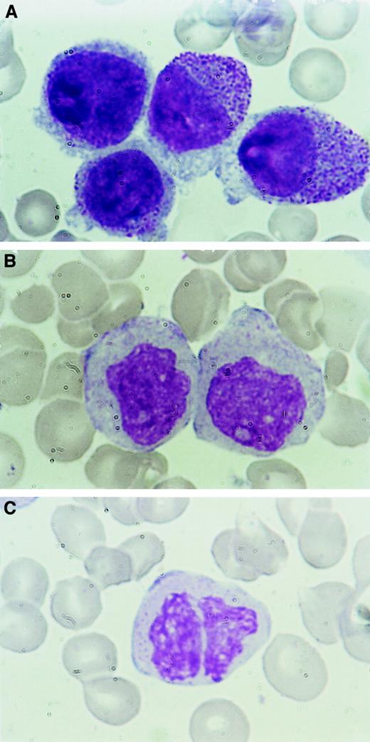 Fig. 2. Morphologic changes in APL cells in BM after As4S4treatment. / (A) Promyelocytes from a patient with APL (patient 8) had dense azurophilic cytoplasmic granules and ectoplasm with Wright stain before treatment. The nuclei had fine chromatin strands and nucleoli. (B) After 18 days of As4S4treatment, cells from the same patient had degranulated cytoplasm. The nuclei had an irregular contour and coarse chromatin strands. (C) Other degenerating cells in the same smear as that in Figure 2B. Original magnification, × 1000.
