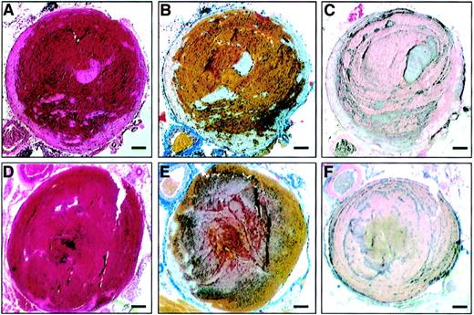 Fig. 2. Vena cava thrombus in wild-type C57BL/6 mice and FVIII−/−mice reconstituted with rhFVIII. / Inferior vena cava thrombosis was induced by ligation of the vein and endothelial damage resulting from short-term localized compression of the vessel. The surgical procedure was performed in wild-type mice (A-C) and FVIII−/− mice reconstituted with 7.5 IU rhFVIII (D-F). Four hours following surgery, mice were killed and thrombi analyzed histologically. (A,D) Hematoxylin/eosin-stained microscopic slide of a transverse section. (B,E) MSB stain with red cells, yellow; fresh fibrin, red; mature fibrin, blue/gray. (C,F) Immunostaining of platelets forming dark gray lines of Zahn. Magnification bar: 100 μm.