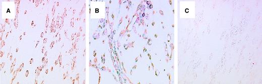 Fig. 6. Immunohistochemistry of mPILSAP protein at the site of angiogenesis in vivo. / Mouse angiogenesis assay was performed as described in “Materials and methods.” Immunostaining of sectioned Matrigel was performed with anti-mPILSAP Ab (panel A), anti-VWF Ab (panel B), or nonimmune rabbit IgG (panel C). Magnification, × 200.
