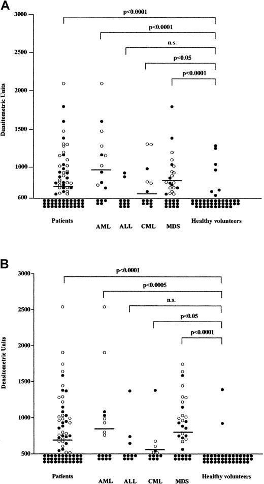 Fig. 4. Detection of WT1 antibodies in patients with hematopoietic malignancies. / (A) Detection of IgM isotype of WT1 antibodies. Closed and open circles represent patients with IgM WT1 antibodies alone and with IgM+IgG WT1 antibodies, respectively. The longitudinal axis represents densitometric units of the IgM isotype of WT1 antibodies. (B) Detection of IgG isotype of WT1 antibodies. Closed and open circles represent patients with IgG WT1 antibodies alone and with IgG+IgM WT1 antibodies, respectively. The longitudinal axis represents densitometric units of the IgG isotype of WT1 antibodies.