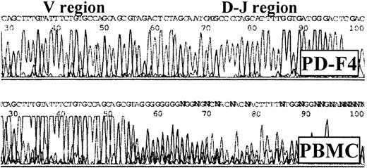 Fig. 2. Sequence of Vβ1 fragment amplified from PD-F4 by RT-PCR. / Note the unambiguous D-J region sequence for PD-F4, consistent with a monoclonal origin, in comparison with the ambiguous counterpart from PBMCs.