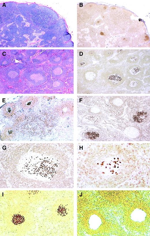Fig. 1. Histopathology and bcl-2 immunohistochemistry of in situ follicular lymphoma. / (A-B) Low-power view of H&E-stained (A) and bcl-2–stained (B) sections showing preserved nodal architecture with open sinuses and prominent paracortex. In B, focal germinal centers (GCs) stain strongly positive for bcl-2, 25 × (case no. 4). (C-D) In this case, most follicles have sharply demarcated lymphoid cuffs resembling reactive GCs (C; H&E). A bcl-2 stain (D) reveals a variable number of cells strongly positive for bcl-2, with some GCs containing only rare bcl-2+ cells. Note that the intensity of the bcl-2+ cells is much higher than that of mantle zone cells and T-lymphocytes, 50 × (case no. 11). (E-F) Stains for bcl-2 show focal GCs strongly positive for bcl-2 protein with some adjacent GCs being completely negative. (immunoperoxidase, hematoxylin counterstain, 50 ×) (case nos. 6, 7). (G-H) At higher power, strongly bcl-2+ cells resemble centrocytes, and are seen amid a bcl-2− GC (immunoperoxidase, hematoxylin counterstain, 100 ×, 200 ×) (case no. 11). (I-J) An example of bcl-2–stained sections before (I) and after (J) microdissection of bcl-2+ follicles as viewed from the microdissection microscope (immunoperoxidase, no counterstain, 50 ×) (case no. 11).