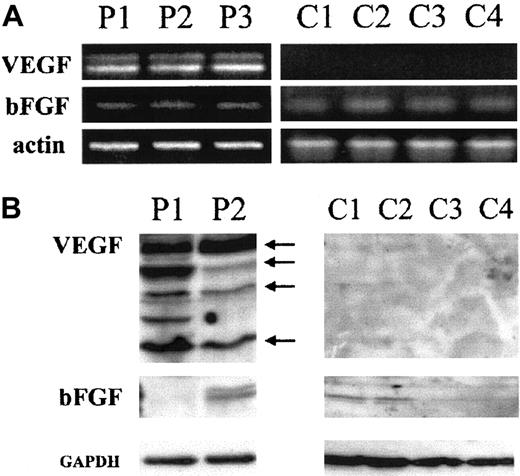 Fig. 2. Fresh ATL leukemic cells express VEGF and bFGF. / (A) Analysis of VEGF and bFGF mRNA isoforms. Fresh leukemic cells from 3 patients with acute ATL (P1, P2, and P3) and fresh lymphocytes from 4 healthy controls (C1, C2, C3, and C4) were analyzed for VEGF and bFGF mRNA expression by RT-PCR using 500 ng total RNA. (B) Detection of cell-associated VEGF and bFGF proteins. Total cell extracts from 2 patients with acute ATL (P1 and P2) and fresh lymphocytes from 4 healthy controls (C1, C2, C3, and C4) were analyzed by Western blot using anti-VEGF– and anti-bFGF–specific antibodies. Anti-GAPDH antibodies were used for assessment of protein loading.