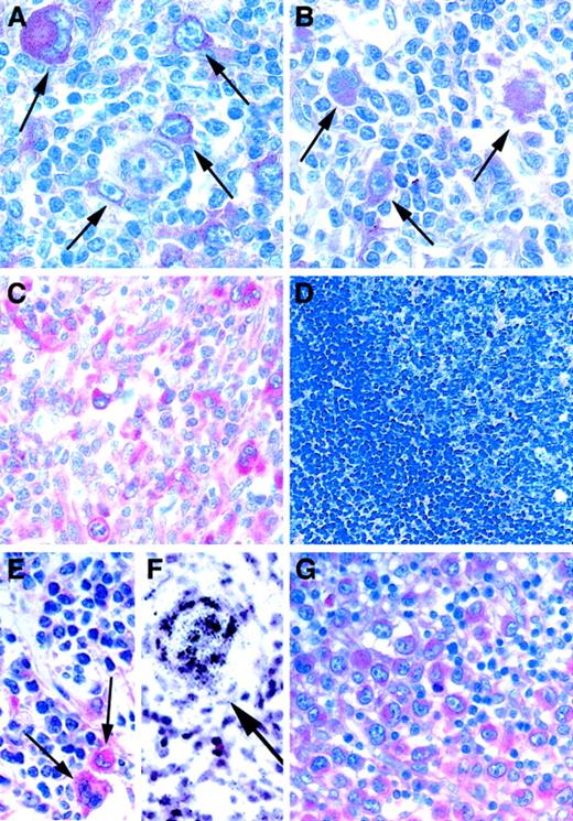 Fig. 1. Lymph node biopsy specimens of cHD and ALCL. / (A-D) Paraffin-embedded sections immunostained for Notch1 and counterstained with hematoxylin. HRS cells (A, B; arrows) with bilobed or multilobed nuclei, huge inclusionlike nucleoli, and abundant cytoplasm and (C) large pleomorphic cells with prominent nucleoli, ALCL tumor cells, are intensely labeled by anti-Notch1 antibodies. Bystander cells and reactive lymphoid tissue (D) show low to undetectable immunoreactivity levels against Notch1. (E, G) Immunostaining for Jagged1. Jagged1 is expressed in HRS cells (E, arrows) and in tumor cells of ALCL (G). (F) Radioactive in situ hybridization of a case of cHD with probes specific for Jagged1. Endothelial and smooth muscle cells show abundant Jagged1 mRNA expression (arrow). Original magnification × 200 (A-C), × 100 (D), × 200 (E-G).