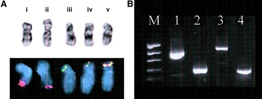 Fig. 1. Confirmation of ETVG-ABL t(9;12)translocation. / (A) Cytogenetic and FISH results. (i) Normal chromosome 9 with normal ABL signal (red), (ii) add(9)(q34) with diminished ABL FISH signal, (iii) normal chromosome (12) with normal ETV6 signal (green), and (iv, v) 2 copies of der(12) showing yellow fusion signal in simultaneousETV6-ABL FISH. (B) Agarose gel electrophoresis of RT-PCR products. Lanes: M, molecular weight marker (pEMBL18 digested with TaqI); 1, ETV6 (TelE+ ↔ TelC-); 2,ABL (NIb+ ↔ Jc-); 3,ETV6-ABL (TelE+ ↔ Jc-); 4,ETV6-ABL (TelA+ ↔ CA3-). The larger and stronger band on lane 3 corresponds to the type BETV6-ABL transcript, whereas the smaller and weaker band represents the type A transcript. The latter can be more clearly detected with the TelA+ primer, which is closer to theETV6 exon 4–ABL exon 2 junction, as shown on lane 4.