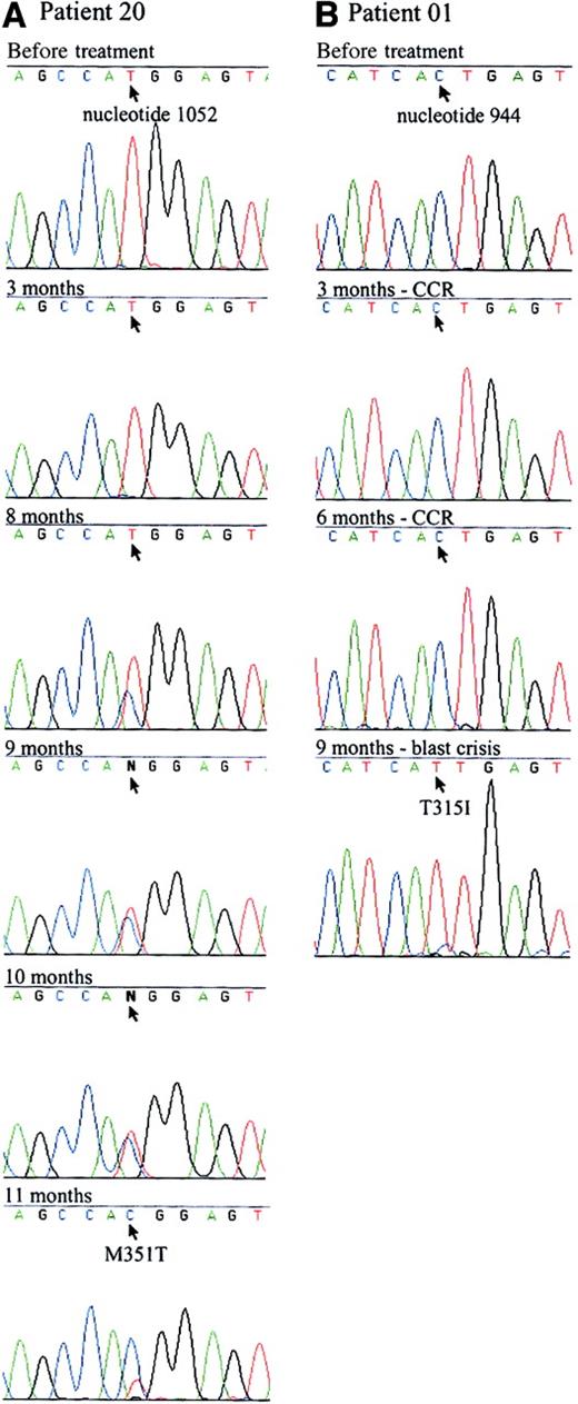Fig. 1. Sequence analysis of 2 patients with point mutations in the ATP binding site. / The 863-bp RT-PCR products of the ABL kinase domain of BCR/ABL were sequenced. Arrows indicate the mutated nucleotide. (A) A point mutation was first detected in patient 20 (Table 1) at the eighth month of imatinib therapy. A mix of mutant and wild-type BCR/ABL was evident from months 8 to 11. The predominant nucleotide switched from wild-type to mutant over the course of 4 months. Sequence Navigator software (Applied Biosystems, Foster City, CA) was unable to distinguish between the wild-type and mutant nucleotides at months 9 and 10, as indicated by N at the mutated site. The patient remains in accelerated phase. (B) Patient 1 (Table 1) had a complete cytogenetic response (CCR) to imatinib therapy but relapsed into blast crisis at 9 months. The T315I mutation was predominant at that time but was not evident when tested before study in chronic phase or in a previous lymphoid blast crisis sample. The patient was refractory to treatment and has since died.