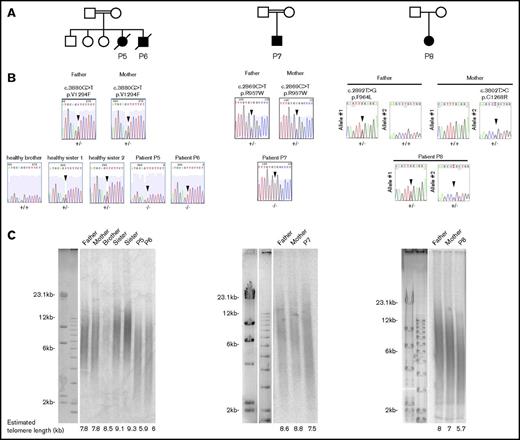 Figure 1. RTEL1 mutations identified in 4 novel patients. (A) Pedigrees of the patients’ families. (B) Direct Sanger sequencing of the RTEL1 gene in the patients, the healthy siblings, and their parents. Sequencing was performed on DNA extracted from blood samples. Arrows indicate the position of the mutations. (C) Mean telomere lengths of whole blood cells from patients, their parents, and healthy siblings were estimated by the TRF method. The estimated telomere lengths are indicated.