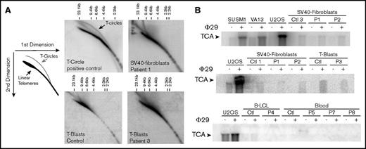 Figure 3. T-circle detection by 2-dimensional neutral-neutral gels and T-circle amplification assays. (A) Two-dimensional gel analysis of telomeric DNA from a T-circle positive control (SV40 transformed fibroblasts overexpressing the telomerase TERT-encoding gene) reveals an additional signal corresponding to T-circles. Two-dimensional gel analysis of telomeric DNA from SV40-transformed fibroblasts from P1 and activated T cells (T-blasts) from P3 did not reveal T-circle signal. (B) Detection of T-circles by T-circle amplification in different positive controls (ie, alternative lengthening of telomere–positive cells SUSM1, VA13, and U2OS), but not in SV40-fibroblats, T-blasts, B lymphoblastoid cell line, and blood cells from healthy controls and RTEL1-deficient patients P1-P8.