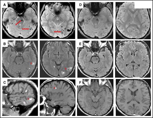 Figure 1. Magnetic resonance imaging of involved brain in HCL before and after chemoimmunotherapy. (A) Axial gradient-echo (GRE) sequence demonstrates innumerable microhemorrhages scattered throughout the supratentorial and infratentorial brain involving both cerebral and cerebellar hemispheres as well as the brainstem (arrows). (B) Axial fluid-attenuated inversion recovery (FLAIR) and (C) sagittal T1 sequences demonstrate multiple small acute hemorrhages at the gray-white junction in the supratentorial and infratentorial brain (these were hyperdense on unenhanced computed tomography scan; not shown) (arrowheads). (D) Axial GRE sequence after chemoimmunotherapy shows multiple microhemorrhages scattered throughout supratentorial and infratentorial brain, consistent with old blood. (E) Axial FLAIR and (F) axial T1 sequences show complete resolution of lesions after chemoimmunotherapy.