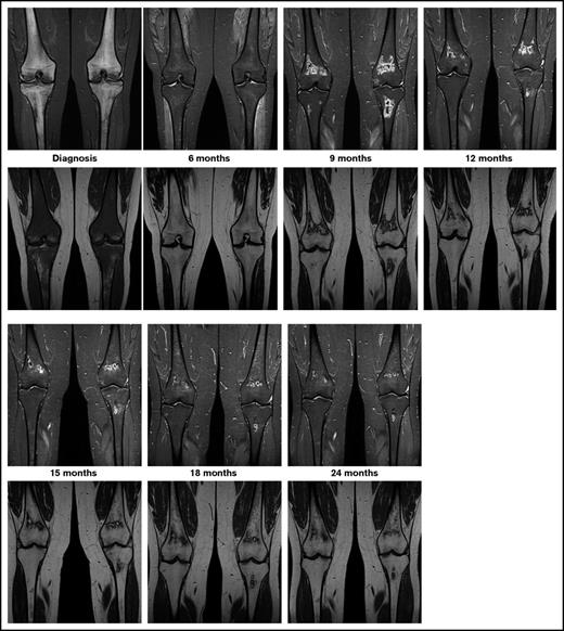 Figure 1. Exemplary patient from the OPAL trial. On coronal images of knees, short tau inversion recovery images (top row) show diffuse hyperintense inhomogeneous signals, and T1-weighted images (bottom row) show diffuse hypointense signals revealing extensive leukemic infiltration of bone at diagnosis. At the 6-month follow-up examination, the hyperintense signal in short tau inversion recovery decreased and the hypointense signal in T1 increased toward normal appearance. At 9 months into treatment, MRI shows asymptomatic lesions in the metaphyses, which shows spontaneous regression beginning at 12 months into treatment.