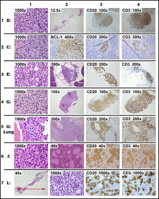 Figure 1. Representative images of xenografts. On day 1, 5 × 106 viable cells of each tumor were injected i.p. Necropsy was performed on day 14 (except row 5, which was performed at 1 month). Representative images from 6 of 20 tumors are shown. Staining was by hematoxylin and eosin (H&E) unless otherwise stated. Row 1: tumor B is a diffuse large B-cell lymphoma. Column 1: xenograft in omentum. Column 2: xenograft (full extent of omental implant). Column 3: CD20 in omentum. Column 4: CD3 in omentum. Row 2: tumor C is a mantle cell lymphoma. Column 1: xenograft in omentum. Column 2: splenic section showing xenograft stained for BCL1 in a white pulp distribution. Column 3: CD20 in spleen. Column 4: CD3 in spleen. Row 3: tumor E is a follicular lymphoma, grade one. Column 1: xenograft in omentum. Column 2: xenograft (representative cross-section of the omental implant with adjacent pancreas). Column 3: CD20 in omentum. Column 4: CD3 in omentum. Row 4: tumor G is a diffuse large B-cell lymphoma. Column 1: xenograft in omentum. Column 2: representative cross-section of the omental implant. Column 3: CD20 in omentum. Column 4: CD3 in omentum. Row 5: tumor G is same tumor as prior row, showing involvement of the lung at 1 month. Columns 1 and 2: xenograft surrounding airway. Column 3: CD20 in lung. Column 4: CD3 in lung. Row 6: tumor J is a follicular lymphoma, grade 2. Column 1: xenograft in omentum. Column 2: white pulp pattern of splenic involvement. Column 3: CD20 in spleen. Column 4: CD3 in spleen. Row 7: tumor L is a follicular lymphoma, grade one. Column 1: xenograft in the omentum (representative cross-section of full omental tissue). Column 2: xenograft in omentum. Column 3: CD20 in omentum. Column 4: CD3 in omentum.