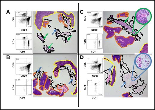 Figure 3. Engraftment of B-cell tumors requires CD4+ tumor-associated cells. A representative experiment using tumor W (MZL) is shown. Qualitatively similar results were also obtained using tumors M (MZL) and J (FL; data not shown). The flow cytometry shows the cellular composition at the time of injection. The omentum with associated mesentery and organs was harvested at 14 days; each panel is a representative section from one of 3 mice in each experimental group. The images show representative sections for each graft that include the omentum (black outline), spleen (yellow), and pancreas (orange). Several examples of the lymphoid tumor within the omental areas are marked with green arrows; examples of uninvolved omentum are marked with blue arrows. (A) Robust engraftment of a tumor that has undergone mock depletion (beads without antibody). After mock depletion and before injection, T cells make up 11% of the specimen with a CD4:CD8 ratio of 1.7, B cells make up 76% of the specimen, and viability was 91%. Next, 1 × 107 cells were injected i.p., and mice were necropsied at 14 days. The grafts of this tumor contains a mixture of B and T cells (Figure 5). (B) Removal of non-B cells from the specimen ablated engraftment (viability after depletion of B cells was 94%; cell number for injection, 7 × 106, was matched to the B-cell number injected in A). (C) CD8+ cells are not required for engraftment. CD8+ cells were depleted by a factor of at least 20-fold. For CD8+ cells (viability after depletion was 79%; cell number for injection was 1 × 107), there was no discernable effect on the tumor volume or B-cell composition (D) CD4+ cells are required for engraftment. The high-power inset shows that the omental areas consist entirely of adipose tissue with a few small vessels, and no tumor is present. Viability at the time of implementation was 83%. (Original magnification ×12.5 and ×400 (insets); the CD4 depletions were assessed with 3 mice each for tumors W, M, and J; the CD8 depletions were performed with 3 mice each on tumors W and M; the various treatments showed essentially indistinguishable results with the various source tumors.)