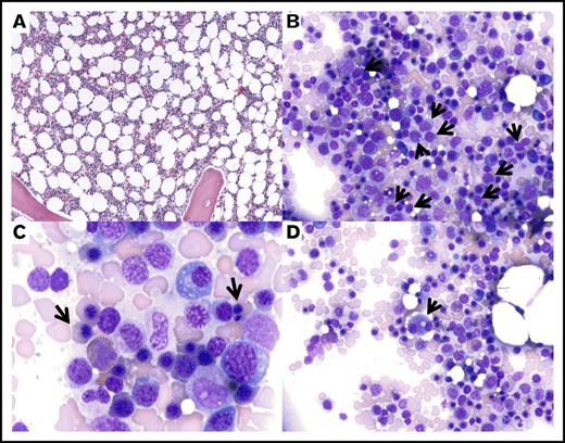 Figure 1. Dysplastic marrow morphology following lenalidomide therapy. Representative images of the bone marrow aspirate from September 2013, showing mildly decreased cellularity for age (A; magnification ×60, hematoxylin and eosin stain) with relative erythroid hyperplasia, slightly increased frequency of blasts (B, arrows; magnification ×240, Wright-Giemsa stain), nuclear abnormalities in the erythroid precursors (C, arrows; magnification ×600, Wright-Giemsa stain), and dysplastic small megakaryocytes with binucleation and separated nuclei (D, arrow; magnification ×240, Wright-Giemsa stain).