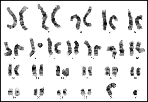 Figure 2. Contemporaneous marrow karyotype showing 1 normal chromosome 7 and 1 probable ring chromosome 7. The other chromosomes have a normal banding pattern (Giemsa stain, 48-hour culture).