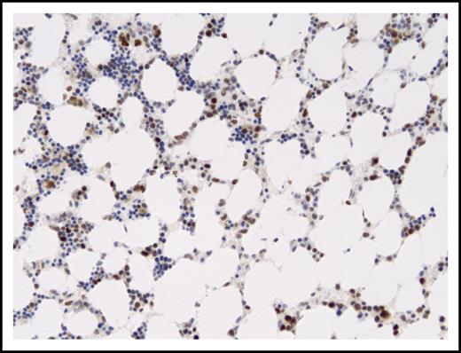 Figure 3. Moderate to strong P53 expression in cells of marrow sample with P53 mutation. P53 immunostained section of marrow from September 2013 (Leica Bond III automated stainer with manufacturer’s antibody). Magnification ×150; immunostain with diaminobenzidine chromogen and hematoxylin counterstain.