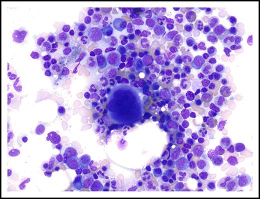 Figure 4. Normal appearance of marrow aspirate on follow-up examination 3 years after discontinuation of treatment with lenalidomide (September 2016). Magnification ×310; Wright-Giemsa stain.