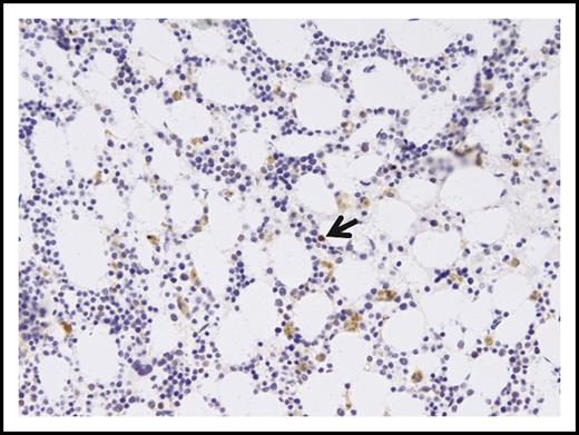 Figure 5. P53 immunostaining of marrow from September 2016. The extracellular brown pigment is hemosiderin. Rare nuclei showed moderate intensity staining (arrow). Magnification ×140; immunostain with diaminobenzidine chromogen and hematoxylin counterstain.
