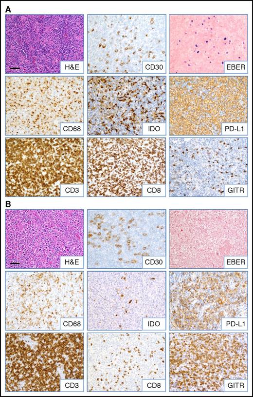 Figure 2. Inflammatory composition of EBV+ and EBV−CHL. Representative images from (A) EBV+ and (B) EBV− CHL (specimens CHL-23 and CHL-12, respectively; see Table 1) are shown. HRS tumor cells are identified by anti-CD30 IHC and EBER ISH. A predominance of CD8+ T cells and IDO+ histiocytes was observed in EBV+ cases, whereas increased GITR+ lymphocytes were seen in EBV− cases. Robust CD3+ T-cell infiltrates and PD-L1 expression on HRS cells and infiltrating immune cells were observed regardless of EBV status. Slides were imaged on an Olympus BX46 microscope with an Olympus DP72 camera at ×200 magnification with an aperture of 0.5, and Olympus cellSens Standard 1.5 image acquisition software was used. Bar, 50 μm. H&E, hematoxylin and eosin.