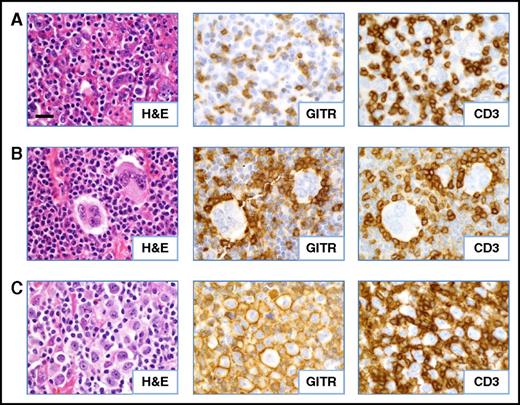 Figure 3. Patterns of GITR expression observed in CHL. Serial FFPE tumor sections were stained as indicated. (A) Diffuse GITR expression on infiltrating T lymphocytes (case CHL-2). (B) Rosettes of GITR+ T cells surrounding HRS tumor cells (case CHL-19). (C) GITR expression on the plasma membrane of a subset of the HRS cells (case CHL-7). All cases shown are EBV− specimens. Slides were imaged at ×500 magnification with an aperture of 0.9. Bar, 20 μm.