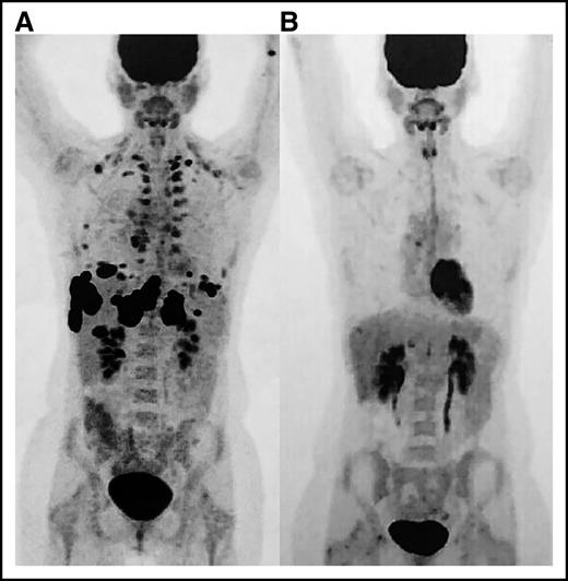 Figure 2. Positron emission tomography (PET) images. (A) Scan prior to initiation of nivolumab and (B) restaging PET after eighth cycle revealing complete remission.