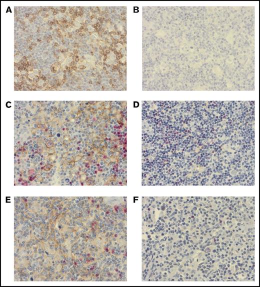 Figure 2. Immunohistochemical stains in the study. High (A) and low (B) proportion of PD-1+ (brown) leukocytes. High (C) and low (D) proportion of PD-L1+ (brown) leukocytes. High (E) and low (F) proportion of PD-L2+ (brown) leukocytes. Red, PAX5. Original magnification ×400 for all panels.