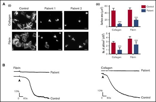 Figure 1. GPVI-deficient patients are unresponsive to fibrin. Glass coverslips were coated with collagen or fibrin as described in "Materials and methods." (Ai) Human platelets (ptl; 20 × 109/L) were allowed to spread on coated coverslips, followed by staining of actin with Alexa-488 phalloidin. The pictures are representative results of a control and 2 GPVI-deficient patients. Scale bar, 5 μm. (Aii) The histograms illustrate the quantification of the surface area of platelets and the number of platelets calculated per millimeter squared. In each independent experiment, 5 random pictures were analyzed (100 platelets in total). The results are shown as mean ± standard deviation. ***P < .001. (B) Representative aggregation traces form a GPVI-deficient patient are shown (the control aggregation trace is representative of >20 donors).