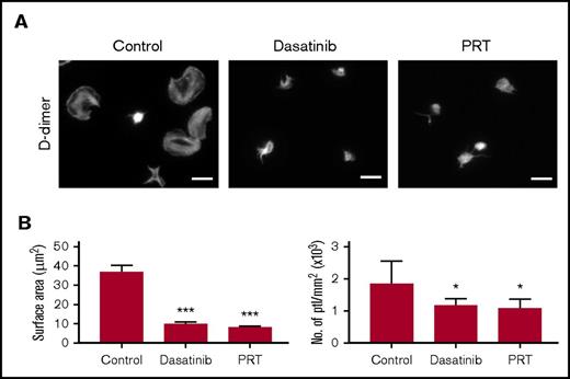 Figure 5. D-dimer–induced spreading is dependent on GPVI signaling. (A) Glass coverslips were coated overnight with D-dimer as described in "Materials and methods." Human platelets (ptl; 20 × 109/L) were preincubated with dasatinib (3 μM), PRT-060318 (10 μM), or vehicle before being allowed to spread on coated coverslips. Actin staining was performed on fixed platelets with Alexa-488 phalloidin. Scale bar, 5 μm. The figure is representative of 3 similar experiments. (B) Quantification of platelet surface area and platelet count per millimeter squared (n = 3). In each independent experiment, 5 random pictures were analyzed (100 platelets in total). The results are shown as mean ± standard deviation. *P < .05, ***P < .001 compared with control.