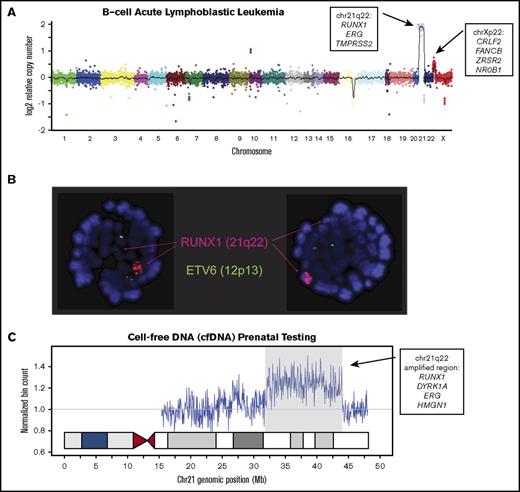 Figure 1. Detection of iAMP21 leukemia by sequencing leukemia cells, fluorescence in situ hybridization analysis, and sequencing cell-free DNA. (A) Estimated DNA copy number via targeted capture sequencing of ∼400 known cancer genes from the patient’s bone marrow, showing amplification (∼6-7 copies) of 3 genes located on 21q22 (RUNX1, ERG, TMPRSS2) as well as copy number gain of Xp, including CRLF2, FANCB, ZRSR2, and NR0B1. (B) Bone marrow metaphase fluorescence in situ hybridization demonstrating multiple signals from a RUNX1 probe (21q22, red) on the marker chromosome and 2 normal (green) signals for ETV6 (12p13). (C) Normalized DNA copy number estimations on chromosome 21 from cfDNA derived from maternal plasma demonstrating an amplification spanning ∼12 Mb of chr21q22 containing RUNX1, DYRK1A, ERG, and HMGN1.