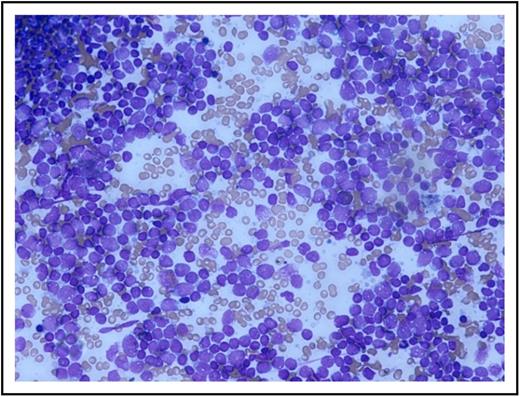Figure 1. Patient’s bone marrow aspirate smear using May-Grünwald Giemsa stain. Image captured using Olympus microscope and camera. Original magnification ×200.