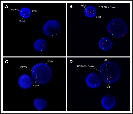 Figure 3. FISH images of sequential hybridization with the Vysis ETV6 break-apart probe and the MetaSystems BCR-ABL1 dual-fusion probe. The left-hand images (A,C) show the first hybridization with the ETV6 probe. The signal pattern shows 1 normal ETV6 signal and separated 3 ′ETV6 and 5 ′ETV6 signals, indicating the ETV6 gene rearrangement (t(12;21)(p13;q22)). The right-hand images (B,D) show the same cells sequentially hybridized with the BCR-ABL1 probe. The signal pattern shows 2 copies of ABL1, 1 copy of BCR, and 1 BCR-ABL1 fusion signal consistent with the BCR-ABL1 gene rearrangement, as demonstrated by molecular techniques. Image captured using Zeiss microscope and MetaSystems image analysis software.
