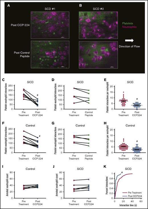 Figure 1. CCP-224 inhibits platelet-neutrophil aggregation in SCD patient blood. (A-B) Human blood was flown through microfluidic channels presenting P-selectin, ICAM-1, and IL-8, and platelet-neutrophil interactions were assessed by using qMFM. qMFM images showing platelets (green circles) interacting with arrested neutrophils (purple polygons) in the blood of SCD patient 1 (A) and patient 2 (B) following treatment with 10 µg/mL of CCP-224 (top row) or control peptide (bottom row). Neutrophils were stained with Alexa Fluor 647 anti-human CD16 Ab (purple), and platelets were stained with fluorescein isothiocyanate anti-human CD49b Ab (green). qMFM images were recorded by using a Nikon Eclipse Ti inverted microscope equipped with a Zyla-5.5 sCMOS scientific camera and CFI Apochromat TIRF 60× oil objective (numerical aperture: 1.49). All microscope functions and image analyses were conducted by using NIS-Elements software. Borders of platelets are marked with green circles. The arrow indicates the direction of flow. Scale bars, 20 µm. The wall shear stress was 6 dyn/cm2. See supplemental Methods for details. (C-D) Pre- and posttreatment paired analyses showing the effect of CCP-224 (C) or control peptide (D) treatment on total platelet-neutrophil interactions in SCD patient blood. (E) Platelet interactions per arrested neutrophil over a 2-minute observation period pre– and post–CCP-224 treatment in SCD human subject blood. (F-G) Pre- and posttreatment paired analyses showing the effect of CCP-224 (F) or control peptide (G) on control (African American as well as white) subject blood. (H) Platelet interactions per arrested neutrophil over a 2-minute observation period pre– and post–CCP-224 treatment in healthy control (African American as well as white) human subject blood. In panels E and H, 5 neutrophils were randomly selected per experiment, and the number of platelets interacting with each neutrophil were counted. Each data point in panels E and H corresponds to interactions with an individual neutrophil; mean ± SE. (I-J) Pre- and posttreatment paired analyses showing the effect of CCP-224 on the total number of arrested neutrophils in healthy control (I) and SCD (J) human blood. (K) Cumulative probability distribution of the lifetime of platelet-neutrophil interactions pre– and post–CCP-224 treatment in SCD human blood. The lifetime of 10 randomly selected platelet-neutrophil interactions were measured in each experiment. Pre- and posttreatment data points connected by a straight line in panels C-D, F-G, and I-J represent paired data from an individual experiment. Blood samples from 3 SCD and 3 control (2 African American and 1 white) human subjects were used. Two to 3 independent experiments were performed per subject. Closed circles, open circles, and open triangles in panels C-D and J represent independent experiments performed with SCD patient 1, 2, and 3, respectively. Closed circles, open circles, and open triangles in panels F-G and I represent independent experiments performed with control subject 1 (African American), 2 (African American), and 3 (white), respectively. #P < .05 post- vs pretreatment.