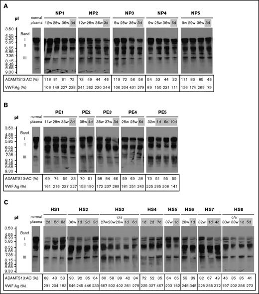 Figure 2. Separation of plasma ADAMTS13:AG by IEF. The week of gestation or the day after delivery is shown at the top of the figure, and plasma levels of ADAMTS13:AC and VWF:Ag are shown at the bottom. The IEF pattern of ADAMTS13:AG in normal plasma is indicated on the left. The number of days postpartum is indicated with a gray background. IEF analysis of each sample was performed in a different gel. (A) In all 5 normal pregnant women (NP), band I of ADAMTS13 (ie, the unbound form of ADAMTS13) slightly decreased during pregnancy. (B) Five patients with preeclampsia (PE) showed no marked changes of IEF patterns, and only patient 3 (PE3) showed a reduction of band I in the postpartum period. (C) All 8 patients with HELLP syndrome (HS) showed a severe reduction of band I, especially in the postpartum period. c/s, cesarean section.