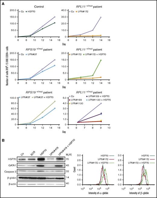 HSP70 overexpression rescued erythroid proliferation and differentiation and decreased the apoptosis of erythroid cells in mutated RPL11+/MutDBA patients. (A) Study of erythroid proliferation (number of cells ×104) between day 6 and days 14 or 15 from CD34+ peripheral blood from various DBA-affected patients carrying a mutation in RPS19 gene (UPN#37) (middle and bottom left plots) or RPL11 gene (UPN#172 (top and middle right plots), UPN#189 (red dot), and UPN#1130 (yellow dot) (bottom right plot) compared with healthy controls (Co) (open circle) or CD34+ cells infected with WT HSP70 cDNA lentivirus (filled circle) (top left plot). Erythroid cells from DBA affected patients have been analyzed with or without WT HSP70 cDNA lentivirus infection. Counting of the erythroid cells has been performed using flow cytometry (shown) and manual count under the microscope in triplicate. Five thousand CD34+ cells have been plated at day 0. Erythroid proliferation has been calculated compared with this number of cells during the time course at days 9, 12, and 14 or 15. (B) Top panel: western blot is shown from the erythroid cells (20 000 cells) obtained at day 10 from CD34+ peripheral blood from a DBA affected patient carrying a mutation in RPL11 gene (UPN#479). CD34+ DBA patients’ cells in erythroid differentiation have been studied without or with wild-type HSP70 cDNA lentivirus infection. HSP70, GATA1, procaspase-3 and β-globin protein expressions have been studied compared with β-actin expression level. Bottom panel: a RPL11+/Mut DBA affected patient exhibited a defect in α-globin and β-globin expression level in accordance with the hemoglobin concentration of the patient. Overexpression of wild-type cDNA HSP70 in erythroid cells from the RPL11+/Mut UPN#172 DBA affected patient restored α-globin and β-globin expression in this patient compared with the normal erythroid cells transduced with wild-type cDNA HSP70. Globin gene expression level has been measured by imaging flow cytometry (ImageStream). (C-D) Representative FACS histogram plots of cultured erythroid cells (10 000 cells) from a healthy control (Co) (left panels), a RPL11+/Mut DBA patient (UPN#1099) (middle panels), and this patient after wild-type HSP70 cDNA lentivirus infection. (C) Apoptosis analysis on the DAPI and annexin V labeling. DAPI−/annexin V+ apoptotic erythroid cells have been quantified in percentage. (D) Erythroid differentiation analysis on the CD34/CD36 labeling. In all the FACS histogram plots, the ordinate and the abscissa measured the number of cells displaying the fluorescent intensity of the different antibody staining.
