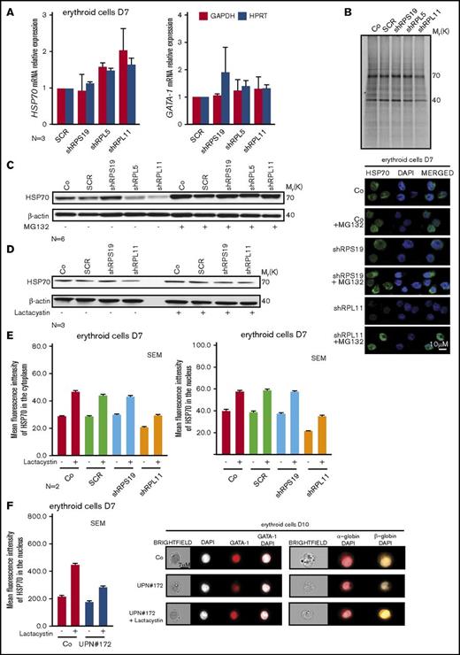 Figure 5. HSP70 decreased expression level is because of a proteasomal degradation. (A) HSP70 and GATA1 gene expression analysis by qRT-PCR in CD34+ human cells, transduced with shRPS19, shRPL5, or shRPL11 relative to the Scramble (SCR) transduced cells and compared with nontransduced cells (Co) at day 7 of erythroid differentiation. The data are shown as the mean ± the standard deviation (for 3 independent samples) and normalized to GAPDH and HPRT reporter genes. (B) Immunoprecipitation of HSP70 protein after S35* metabolic staining of EPO-dependent UT-7 cell line depleted in RPS19 (shRPS19), in RPL5 (shRPL5), or in RPL11 (shRPL11) compared with SCR transduced erythroid cells or nontransduced cells (Co). HSP70 is normally expressed at 70 kDa in each condition. Western blot of HSP70 protein is shown in depleted RPS19 (shRPS19), or RPL11 (shRPL11) erythroid cells compared with controls (Co and SCR), at day 7 after proteasome inhibitor treatment. The cells have been treated with or without MG132 at 10 µM for 1 hour (C) or with or without lactacystin at 50 µM for 2 hours (D). (E) Left panels: Analysis of HSP70 protein expression level in the 2 subcellular compartments (cytoplasm, left panel and nucleus, right panel) of erythroid cells at day 7 of terminal erythroid differentiation in depleted RPS19 (shRPS19), and RPL11 (shRPL11) erythroid cells compared with controls (Co, SCR). The erythroid cells have been treated with or without lactacystin at 50 µM for 2 hours. The results obtained by using imaging flow cytometry (ImageStream) are presented as the MFI ± the standard deviation representative of 3 independent experiments. Right panel: HSP70 protein expression and localization analysis by confocal microscopy in erythroid cells transduced with shRPS19 or shRPL11 compared with nontransduced cells (Co) at day 7 of erythroid culture. The erythroid cells have been treated with or without MG132 at 10 µM for 1 hour. Shown are HSP70, DAPI, and merged HSP70 and DAPI stainings. Original magnification ×60. Scale bar represents 10 µm. (F) HSP70 protein expression into the nucleus of erythroid cells at day 7 of erythroid culture from a DBA-affected patient (UPN#172), carrying a mutation in RPL11 gene (left panel). The erythroid cells have been treated with or without lactacystin at 50 µM for 2 hours. The results obtained by using imaging flow cytometry (ImageStream) are presented as the MFI ± the standard deviation. Representative images obtained using imaging flow cytometry (ImageStream) of GATA1 (middle panel), α-globin and β-globin (right panel) in erythroid cells at day 10 of culture from the RPL11+/Mut mutated DBA-affected patient (UPN#172) compared with a healthy control (Co). The erythroid cells from the DBA patient have been treated with or without lactacystin at 50 µM for 2 hours. Shown standard bright-field images, DAPI, GATA1 and merged GATA1/DAPI, α-globin/DAPI, and β-globin/DAPI stainings. Original magnification ×60. Scale bar represents 7 µm.