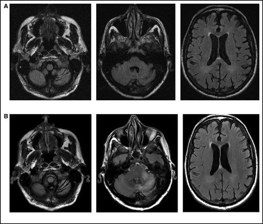 Figure 1. Serial imaging of a patient diagnosed with CLL. Cancer-directed therapy included >6 months of rituximab and idelalisib. (A) Initial magnetic resonance imaging performed 2 months after the onset of headaches and balance disturbance (gait instability and repeated falls) depicting the asymmetric atrophy of the left cerebellum, which was not present in imaging performed 7 months earlier (not depicted). Fluid-attenuated inversion recovery (FLAIR) signal abnormalities are not present elsewhere. (B) Imaging repeated 3 months later (1 month prior to death) showing the continued atrophy of the left cerebellum with new confluent areas of FLAIR signal throughout the left cerebellum and left cerebellar peduncle without enhancement. Again, no FLAIR signal abnormalities are seen in the cerebrum.