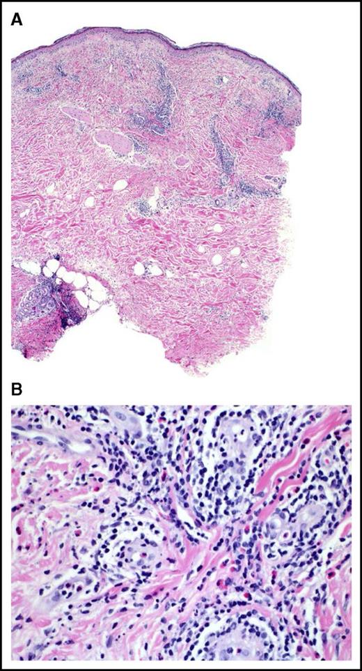 Figure 2. Representative histopathologic response at vaccination site. (A) Hematoxylin and eosin (H&E) 4×: a fully developed reaction to vaccination. Note the prominent infiltration of lymphocytes at all levels of the skin, including the subcutaneous fat. (B) H&E 40×: higher magnification reveals numerous perivascular lymphocytes and eosinophils with perineural infiltration. The endothelial cells of the venules are swollen. There are scattered mononuclear histiocytes present in the infiltrate.