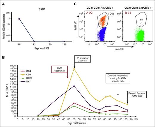 Figure 6. CMV reactivation following megadose haploidentical TCD (following CD3/CD19 depletion) HSCT. (A) Immune resolution of CMV reactivation as indicated by viral DNA titer at different time points. (B) Lymphocyte subset reconstitution in peripheral blood, and time points of FACS analysis of CMV-specific T cells. (C) Enumeration of CMV-specific CD8+ T cells with the Dextramer CMV kit 55 days posttransplant. The host-type anti-CMV CD3+/CD8+/HLA-A02 was present at 214 cells/µL (vs 0 for donor-type CD3+/CD8+/HLA-B35/µL).