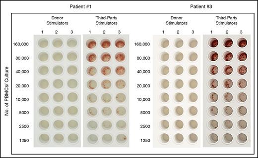 Figure 7. Tolerance induction of donor cells following haploidentical transplantation combining megadose TCD HSCT and high-dose PTCY. Analysis of CTL-p against donor and third-party target cells by IFN-γ ELISpot assay, which measures the frequency of IFN-γ–secreting cells following specific activation at the single-cell level, in PBMCs of patients 1 and 3 at 144 and 117 days following transplantation, respectively (for details, see Materials and methods).