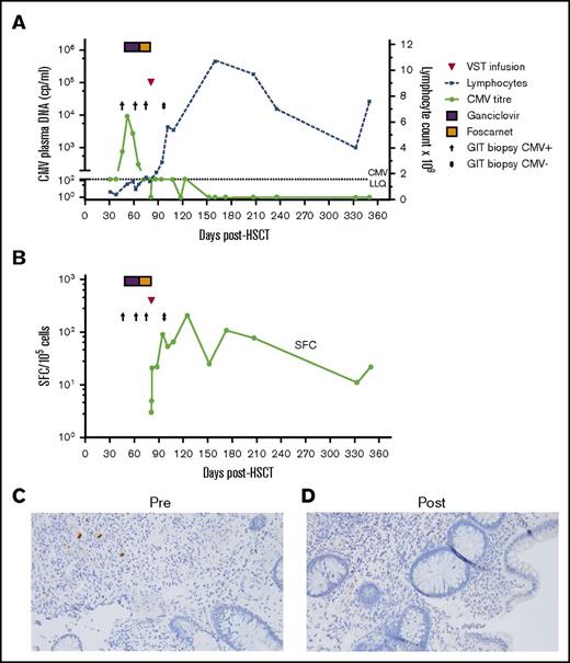 Figure 2. Outcome of CMV enterocolitis in patient 5 post–CMV-specific VST infusion. (A) Viral load, lymphocyte count, and colonic biopsy in patient 5, who was treated with a single VST infusion. The patient had persistent symptomatic biopsy–proven CMV enterocolitis after a month of antiviral therapy. Post–VST infusion, the symptoms resolved, the patient developed an absolute lymphocytosis, and viral load fluctuated between negative and below the level of quantitation (<150 cp/mL). (B) CMV pp65-specific T-cell response as measured by IFN-γ ELIspot. (C-D) Photomicrograph of colonic biopsy with CMV immunostain pre–VST (C) and post–VST (D) infusion (original magnification ×200, Olympus microscope, model BX43). LLQ, lower limit of quantitation.