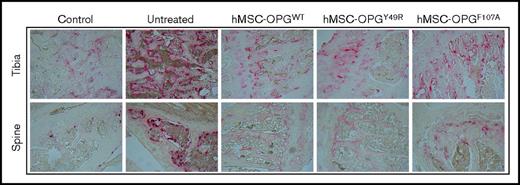 Figure 5. Osteoclast staining in tibia and spine following hMSC-OPG therapy. Bone tissues were harvested from mice in control and indicated treatment groups 28 days following tumor challenge. The bones were decalcified, and 5-µM sections were made. The slides were stained with TRAP stain on both tibia and spine for osteoclast activity within the bone microenvironment. Original magnification ×100.