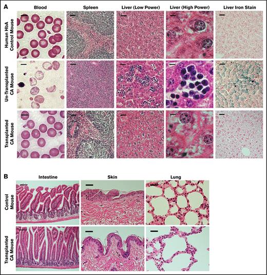 Figure 6. Control and CA mouse histopathological features before and after transplantation. (A) Peripheral blood smears and histopathological features of spleen and liver sections of humanized HbA control, nontransplanted CA, and transplanted CA mice. The morphological status of RBCs in the blood of nontransplanted CA mice shows marked anisopoikilocytosis and hypochromia with numerous nucleated RBCs. In contrast, the blood of transplanted CA mice is normocytic and normochromic, similar to the nonanemic HbA control mice. Nontransplanted CA mice have splenomegaly with a massive expansion of erythroid progenitors, whereas the spleens of transplanted CA mice are normalized, similar to HbA control mice. There is marked extramedullary hematopoiesis and excess iron in the livers of nontransplanted CA mice. After transplantation the livers of CA mice are normalized, similar to control mice. Scale bar is 5 μm for the blood, 50 μm for the spleen, 25 μm for the liver (low power), 5 μm for the liver (high power), and 25 μm for the liver iron stain. (B) Histological sections of the intestine, skin, and lung of wild-type control and transplanted CA mice were examined for evidence of GVHD. Five months after transplantation, the skin, intestine, and lung were fixed and stained with hematoxylin and eosin. No GVHD was observed in CA mice after BMT in the absence of cytoreductive conditioning. Scale bar is 100 μm for the intestine and 50 μm for the lung and skin.
