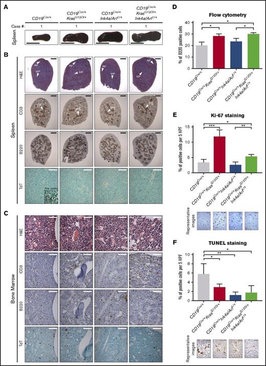 Figure 1. Analysis of 8-week-old mice with conditional expression of KrasG12D and loss of Ink4a/Arf. (A) Representative gross pictures of dissected spleens from mice of the indicated genotypes. Scale bar, 1 cm. (B-C) Representative histologic and IHC analyses of CD3, B220, and TdT expression in (B) spleens and (C) BM from mice of the indicated genotypes. Inset, positive control: TdT staining of thymus from the same mouse. Scale bars: black, 1 mm; white, 50 µm (see supplemental Figure 2). (D) Mean percentage of B220+ cells assessed by flow cytometry in splenocytes from mice of the indicated genotype; error bars represent ± standard deviation (SD) of 3 different mice per genotype. P values were calculated by using Welch’s t test. (E-F) Differences in the number of proliferating and apoptotic cells assessed by Ki-67 (E) IHC analysis of B-cell areas and (F) TUNEL assay of germinal center areas, respectively, in spleens from mice of the indicated genotypes, calculated using ImageJ. Bar plots represent mean number of cells per 5 high-power fields (HPFs); error bars ± SD. P values were calculated by using Welch’s t test. Representative images are shown below the graphs. Scale bar, 25 µm. Two independent assays were performed for all experiments for which statistics were calculated. *P ≤ .05, **P ≤ .01, ***P ≤ .001. H&E, hematoxylin and eosin; PS, periarterial sheath; RP, red pulp; WP, white pulp.