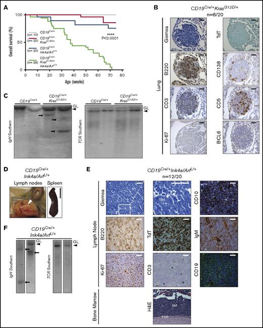 Figure 3. Development of a clonal low-grade B-cell lymphoma and pre-B-ALL in engineered mice. (A) Kaplan-Meier survival plots illustrating overall survival of mouse cohorts according to genotype. P values were calculated by using the log-rank test. (B) Histologic and IHC stains of indicated markers in a representative example of low-grade B-cell lymphoma involving the lungs of a CD19Cre/+KrasG12D/+ mouse. Scale bar, 25 µm (see supplemental Figure 4). (C) Southern blot analysis for the immunoglobulin heavy chain (IgH) (left) and T-cell receptor (TCR) (right) genes in the same genomic DNA isolated from CD19Cre/+ LNs and CD19Cre/+KrasG12D/+ lymphomas. Clonal bands are present for the IgH gene (arrows) but not for TCR (see supplemental Figure 6D). (D) Representative gross pictures of enlarged LNs (white arrow) and spleen from CD19Cre/+Ink4a/ArfL/+ mouse with pre-B-ALL. Scale bar, 1 cm. (E) Histologic, IHC, and immunofluorescent stains of indicated markers in LNs and BM from representative CD19Cre/+Ink4a/ArfL/+ mouse with B-ALL. CD19 staining shown in green with blue 4′,6-diamidino-2-phenylindole (DAPI) nuclear counterstain. Note cytoplasmic expression of IgM in B-ALL cells. TBG, tingible body macrophage. Scale bars: white, 25 µm; black, 50 µm (see supplemental Figure 5). (F) Southern blot analysis for the IgH (left) and TCR (right) genes in the same genomic DNA isolated from CD19Cre/+Ink4a/ArfL/+ leukemias. Clonal bands are present for the IgH gene (arrows) but not for TCR. GL, germ line band.
