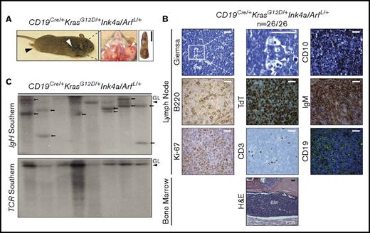 Figure 4. Development of a fully penetrant, highly aggressive B-ALL in KrasG12D/+ and Ink4a/Arf double-mutant mice. (A) Representative images of enlarged LNs (middle, white arrows) and spleen (right) from a CD19Cre/+KrasG12D/+Ink4a/ArfL/+ mouse with pre-B-ALL. Representative whole-body photograph of CD19Cre/+KrasG12D/+Ink4a/ArfL/+ mouse with pre-B-ALL (left). White arrow denotes cervical lymphadenopathy; black arrow denotes lagging hind-limb paralysis due to peridural space involvement. Scale bar, 1 cm. (B) Histologic, IHC, and immunofluorescent stains of indicated markers in LN and BM from a representative CD19Cre/+KrasG12D/+Ink4a/ArfL/+ mouse with B-ALL. CD19 staining is shown in green with blue DAPI nuclear counterstain. Note cytoplasmic expression of IgM in B-ALL cells and infiltration of B-ALL cells in the BM and peridural space (PDS) contributing to paralysis (bottom H&E). Scale bars: white, 25 µm; black, 50 µm (see supplemental Figure 5). (C) Southern blot analysis for IgH (left) and TCR (right) genes in the same genomic DNA isolated from CD19Cre/+KrasG12D/+Ink4a/ArfL/+ leukemias. Clonal bands are present for the IgH gene (arrows) but not for TCR. Absence of GL band in some tumor DNA samples indicates almost complete replacement with lymphoma cells.