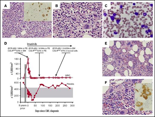Figure 1. Chronic myeloid leukemia (CML) therapy unmasks effects of coexistent CALR mutation. (A-B) BM biopsy obtained at the time of CML diagnosis. Representative hematoxylin and eosin–stained sections from the core biopsy are shown at ×20 (A) and ×40 magnification (B). (A) Inset shows CD61 immunohistochemical stain highlighting megakaryocytes at ×20 magnification. (C) Wright Giemsa–stained PB smear obtained at time of CML diagnosis. Original magnification ×50. (D) BCR-ABL1 fusion transcript and CALR-mutant allele frequency are quantitated in relationship to blood parameters as a function of time. Normal range of blood parameters is indicated by gray bars. (E-F) BM biopsy obtained at 6 months after initiation of imatinib therapy. Representative hematoxylin and eosin–stained sections from the core biopsy are shown at ×20 (E) and ×40 magnification (F). (F) Inset shows CD61 immunohistochemical stain highlighting megakaryocytes at ×20 magnification.